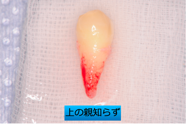 親知らずは悪者なのか？？　〜歯の移植という選択肢〜