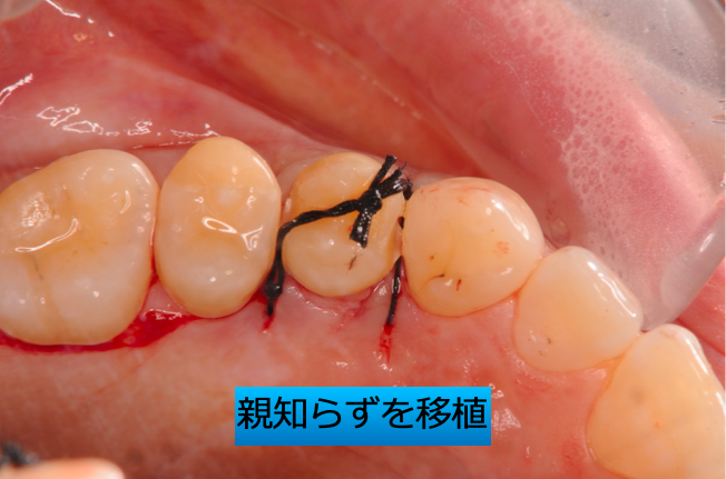 〜歯の移植という選択肢〜