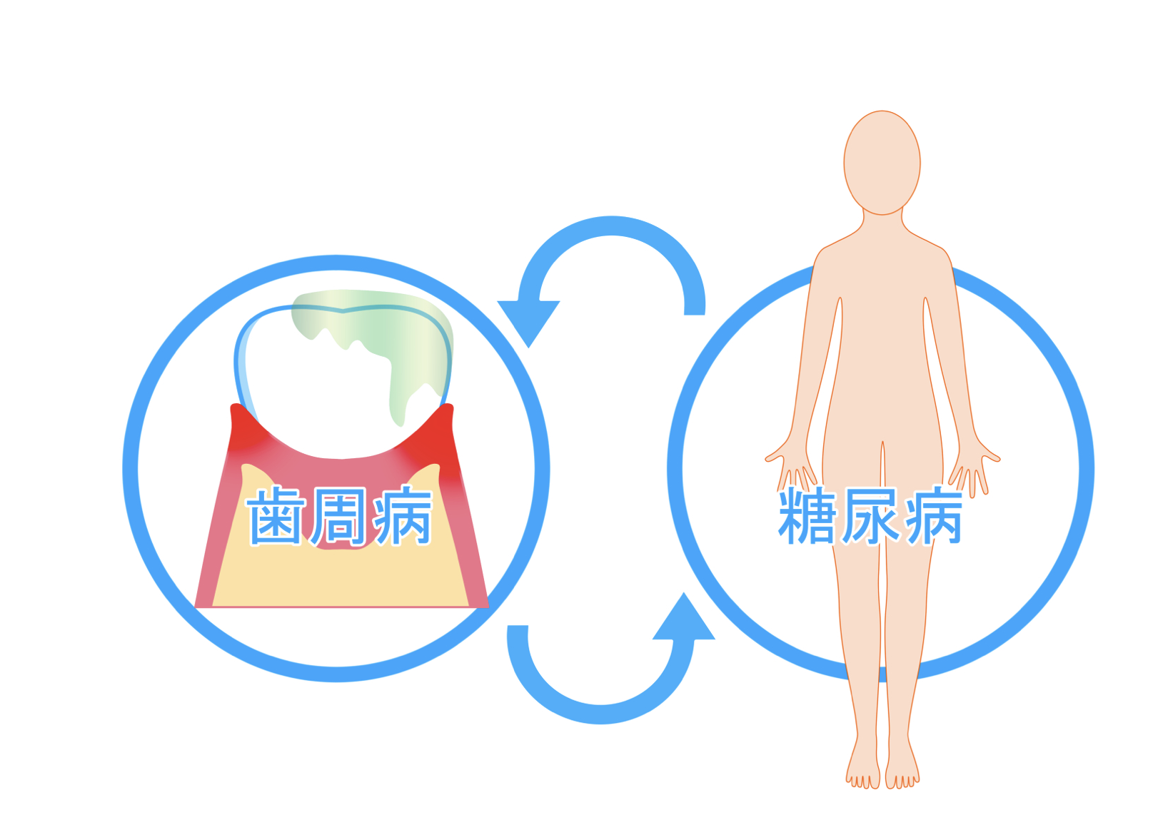 糖尿病の第6の合併症：歯周病との関わり