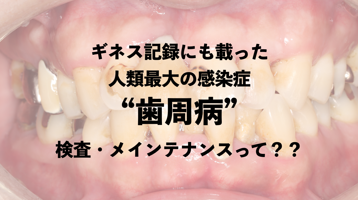 ギネス記録にも載った人類最大の感染症”歯周病”