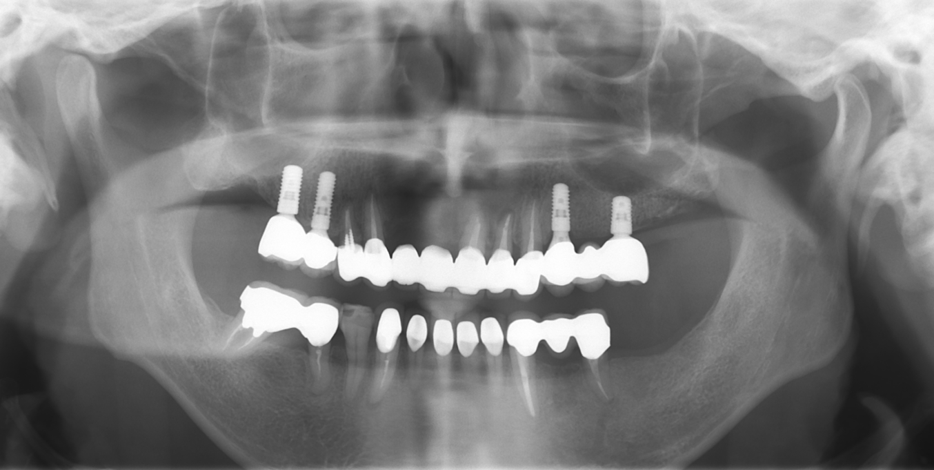 Part 1 インプラント治療における全身状態の診査