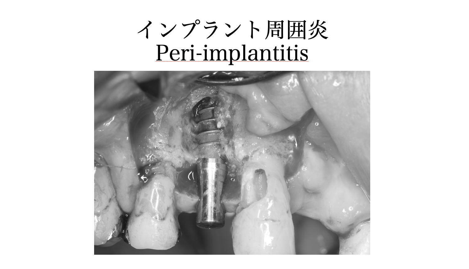 歯周病とインプラントは切り離して考えられません！