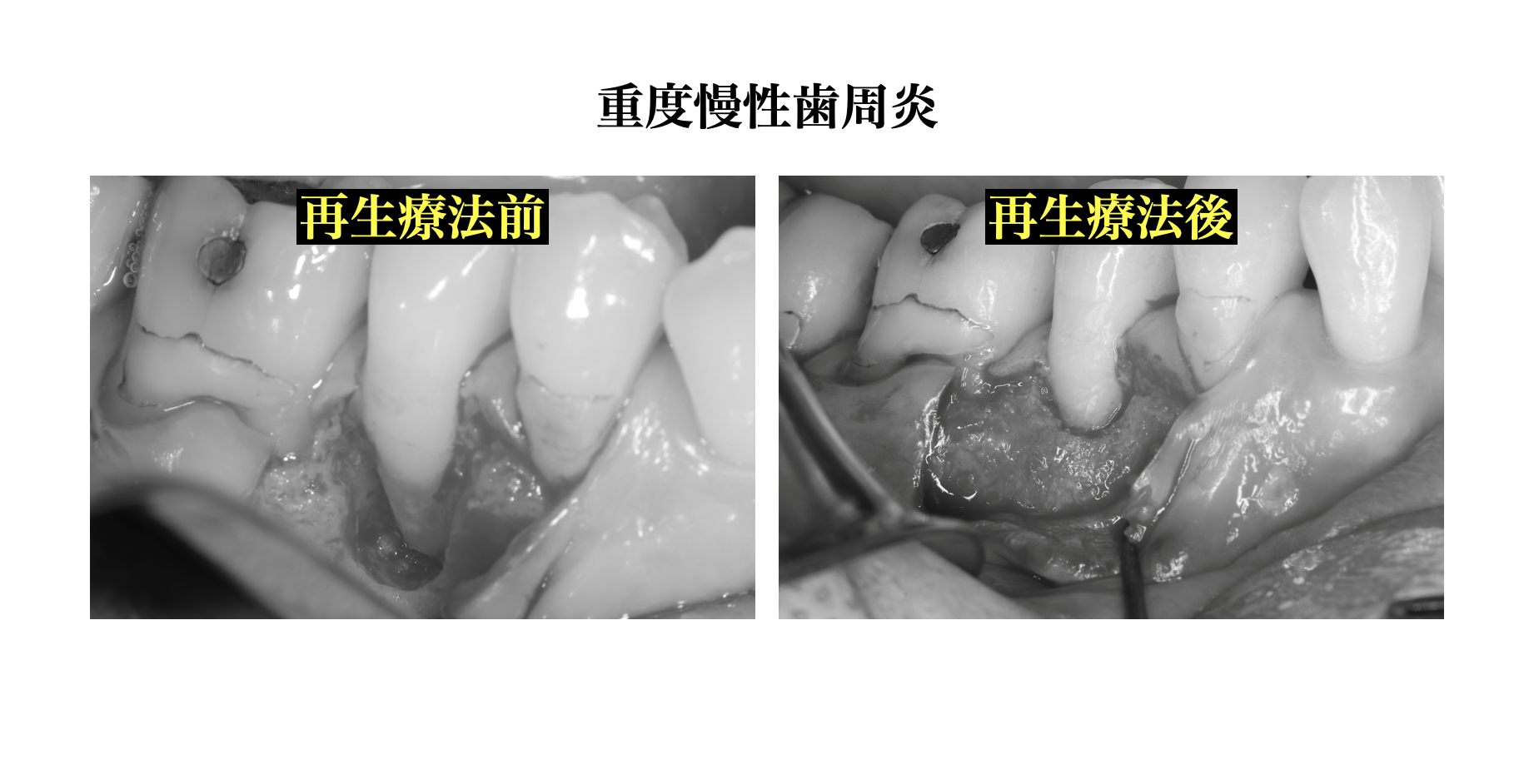 「抜歯しかない」と言われた歯は本当に残せない？歯周病専門医が解説｜戸越なかやま歯科