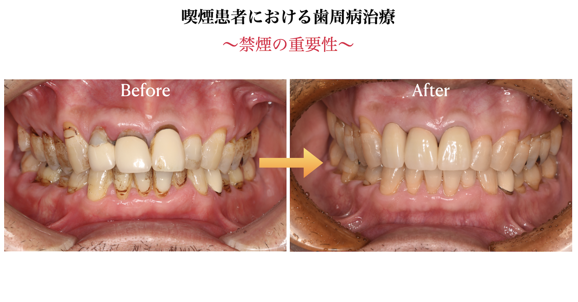 歯周病の重症度は何で変わる？喫煙・タバコと歯周病の関係を専門医が解説｜戸越なかやま歯科