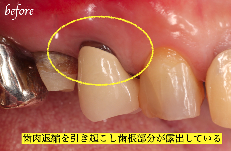 初診時口腔内写真