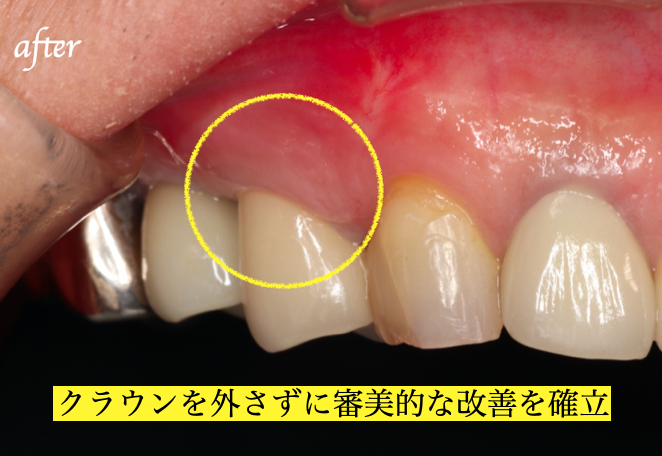 メインテナンス時の口腔内写真