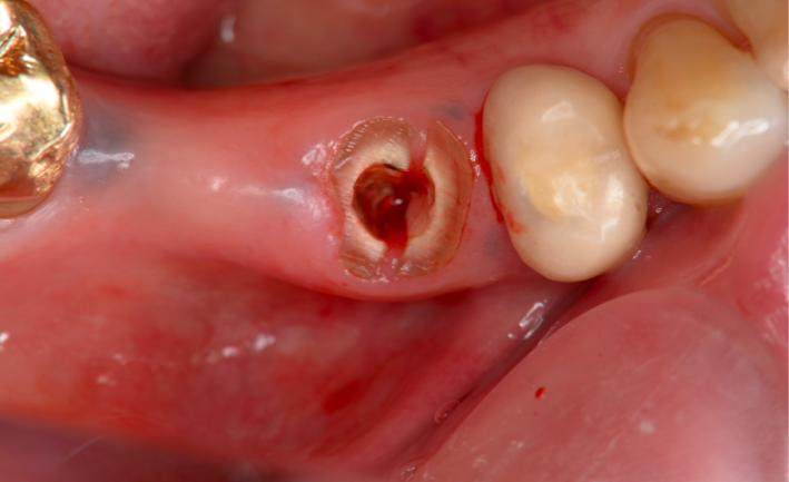 右側下顎第二小臼歯はポストを除去すると縦破折していた