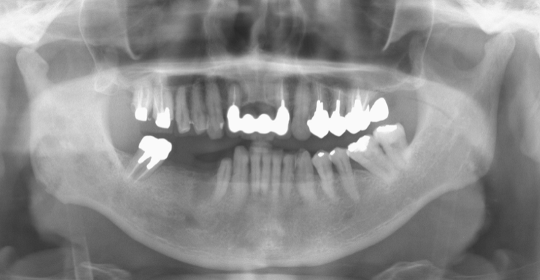 右側下顎臼歯部欠損している