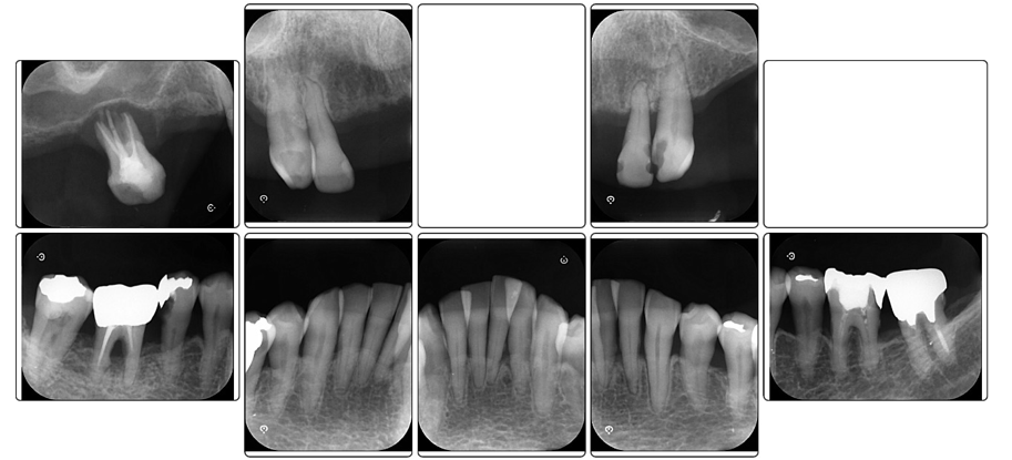 初診時のデンタルエックス線写真