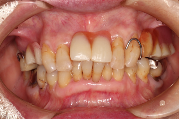 初診時の口腔内写真
