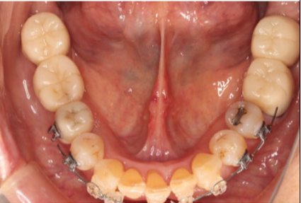 下顎前歯部の叢生が改善