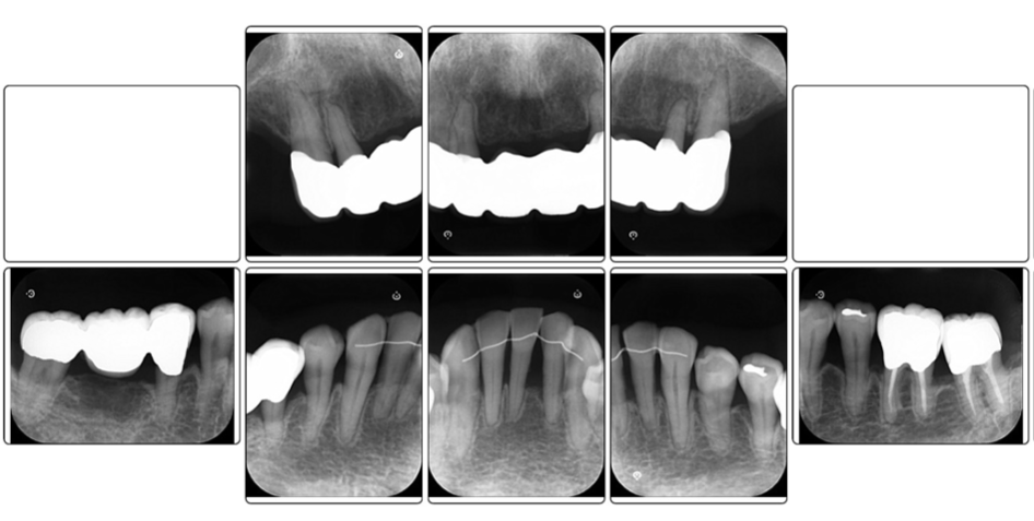 メインテナンス時のデンタルエックス線写真