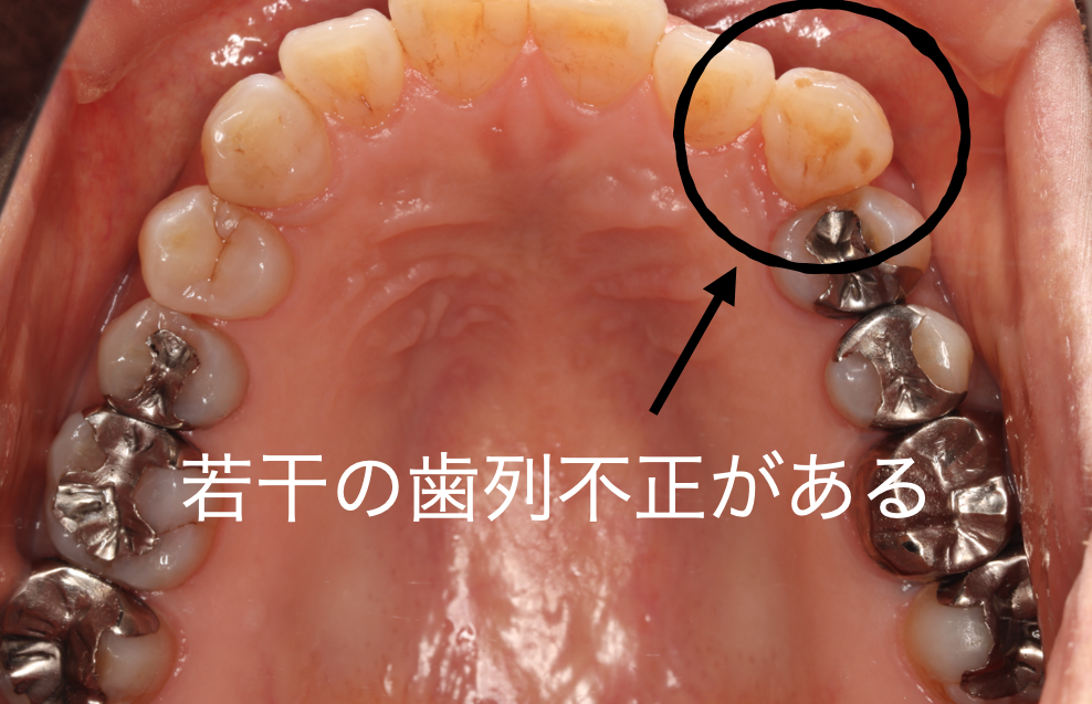 咬合面から見るとやや歯列不正がある