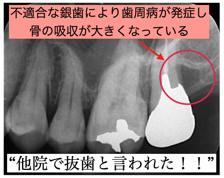 初診時のデンタルエックス線写真