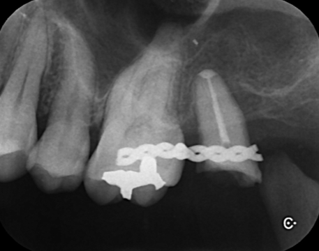 術後４ヶ月　歯の周囲の骨の再生を認めている