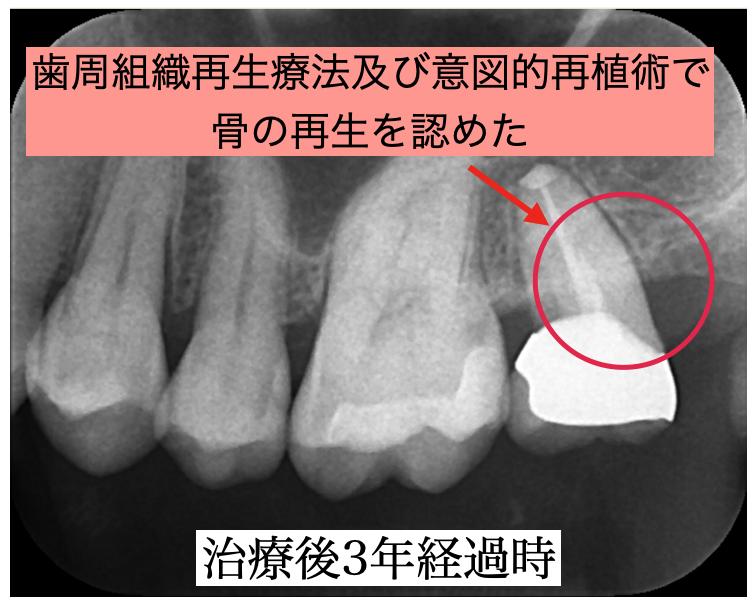 治療後3年経過時のデンタルエックス線写真