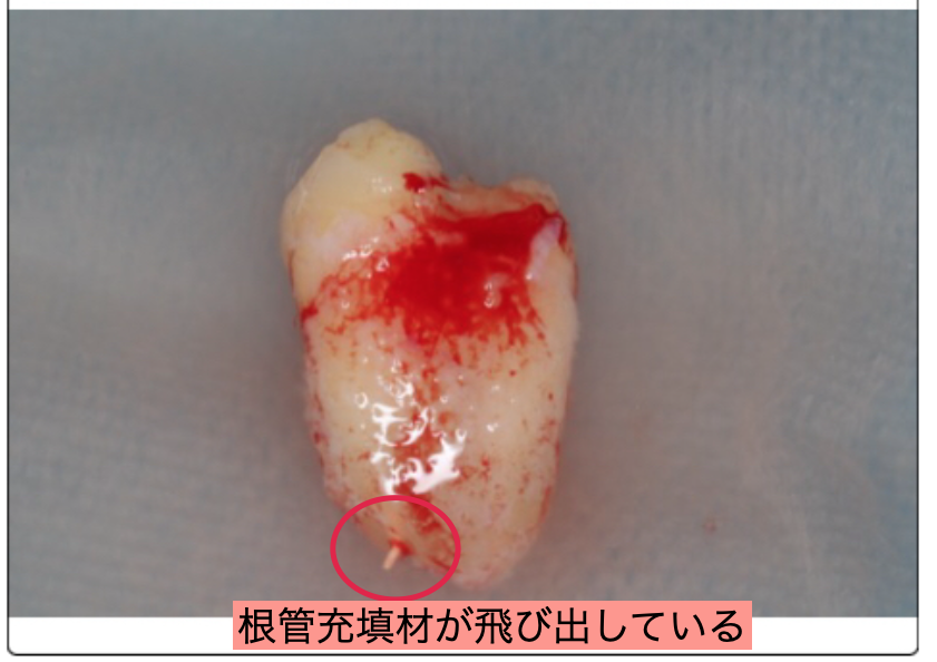 再植するために一度歯を抜歯