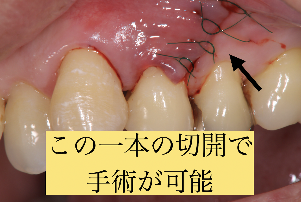 縫合時の口腔内写真