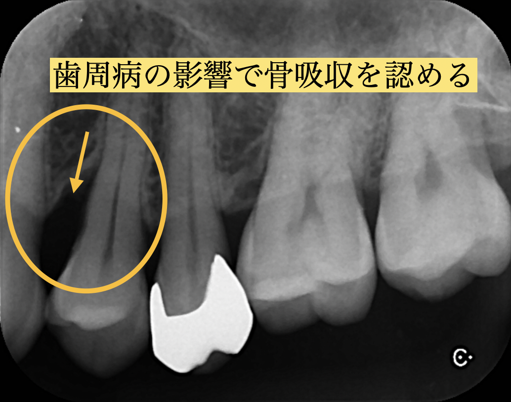 初診時のデンタルエックス線写真