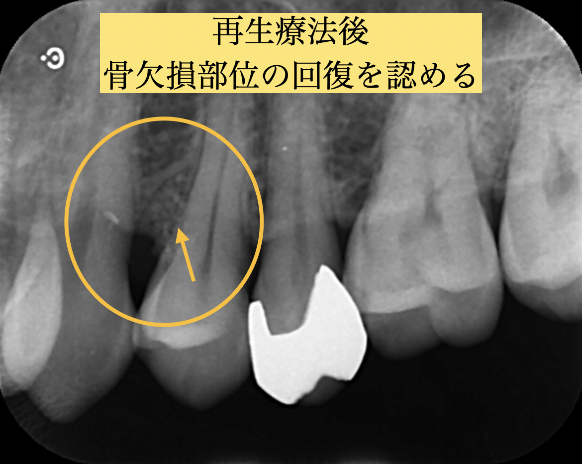再生療法後のデンタルエックス線写真