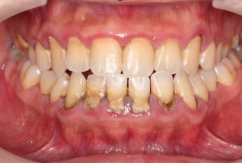 初診時の口腔内写真