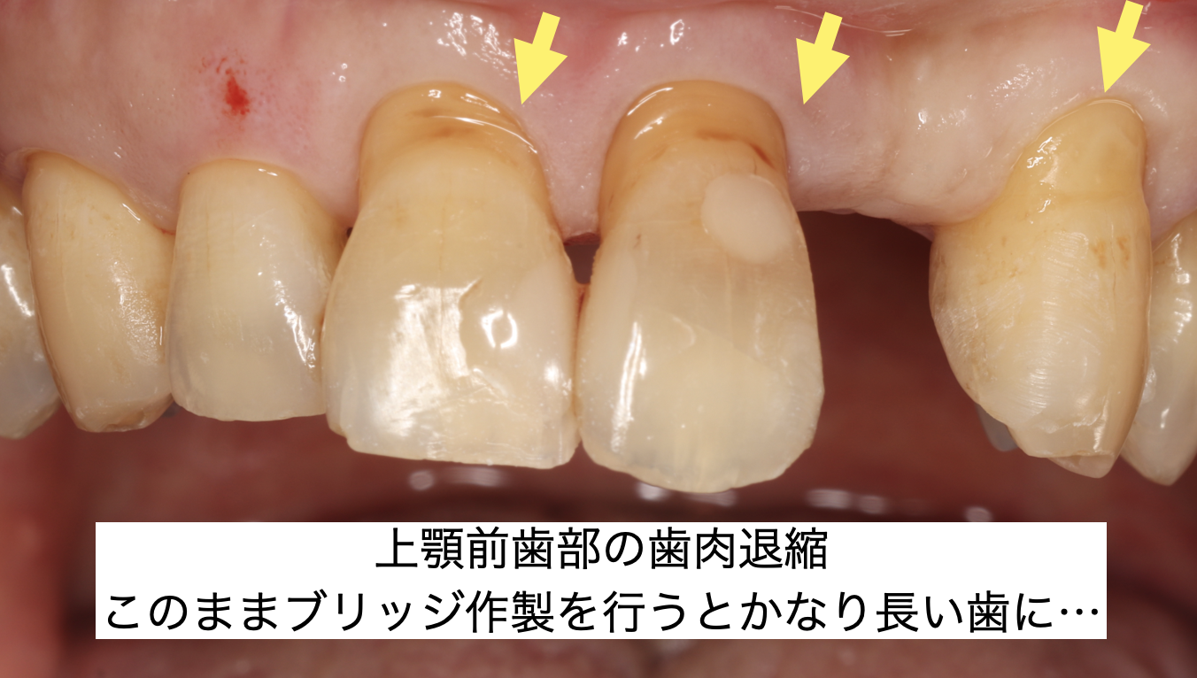 初診時：左上２番欠損に対してブリッジ作製希望で来院