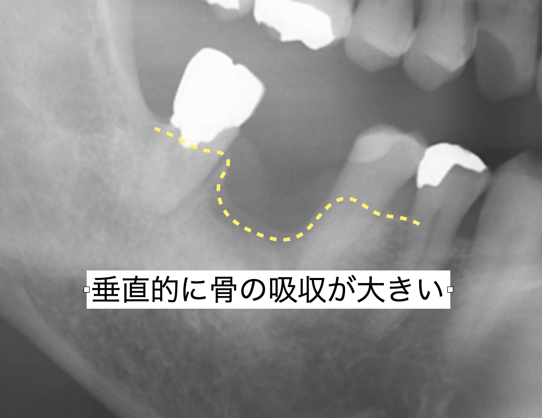 GBR前：骨が垂直的に欠損している