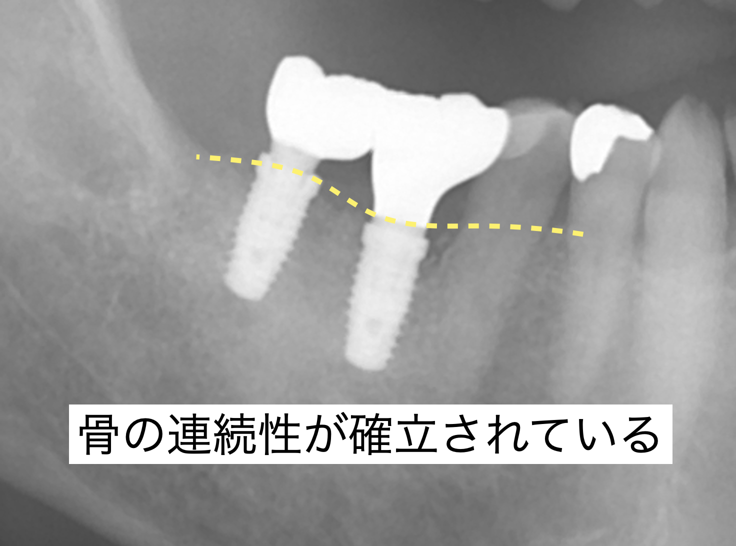 上部構造セット後経過時：骨レベルは安定している