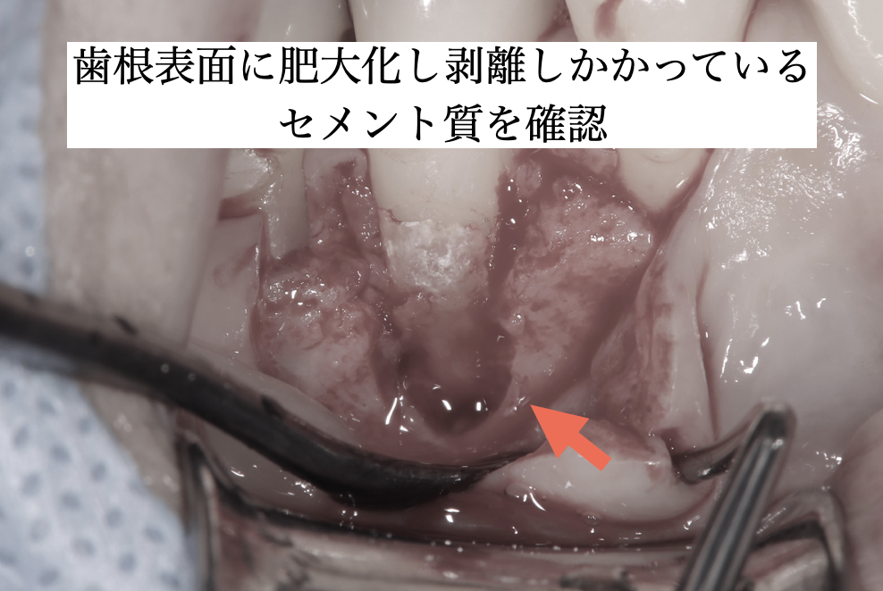 歯根表面の滑沢化前