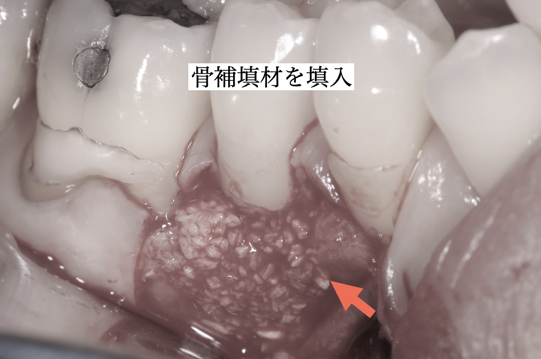 骨補填材を使用