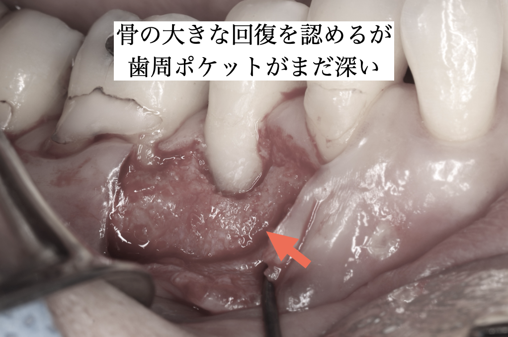 骨の再生を認める