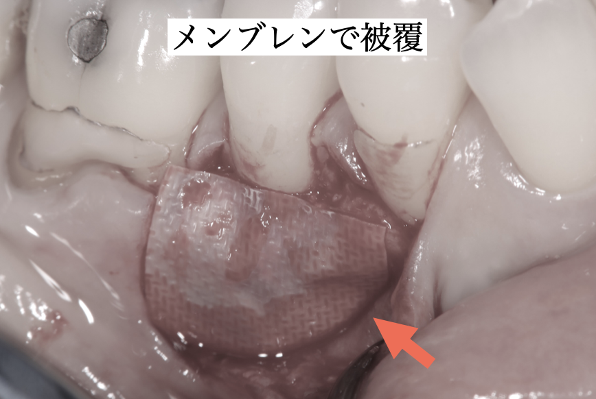 吸収性メンブレン設置