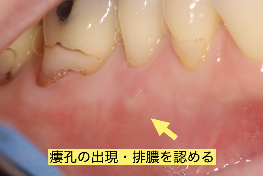 瘻孔の出現と排膿を確認