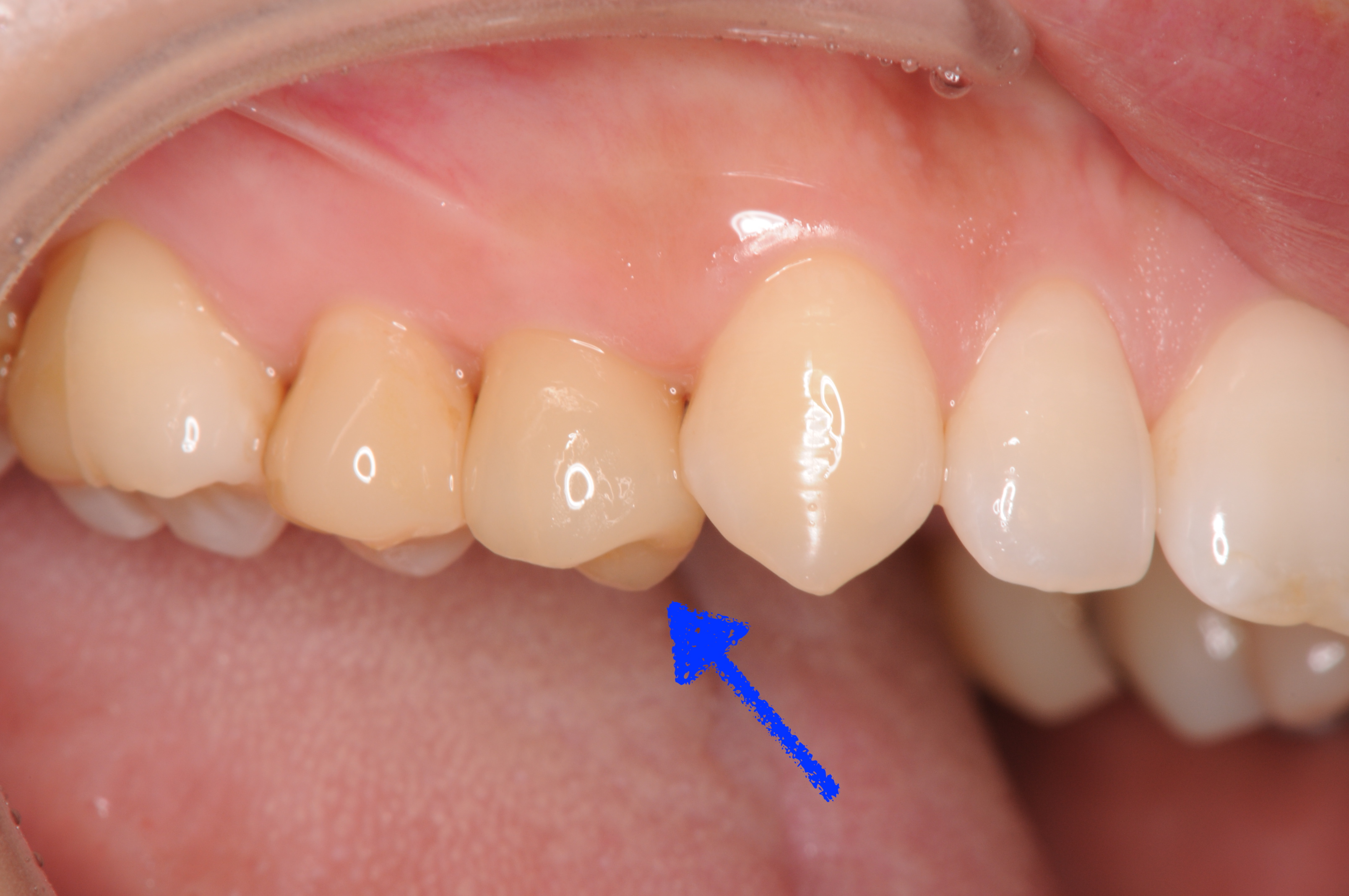移植歯周囲の組織の安定