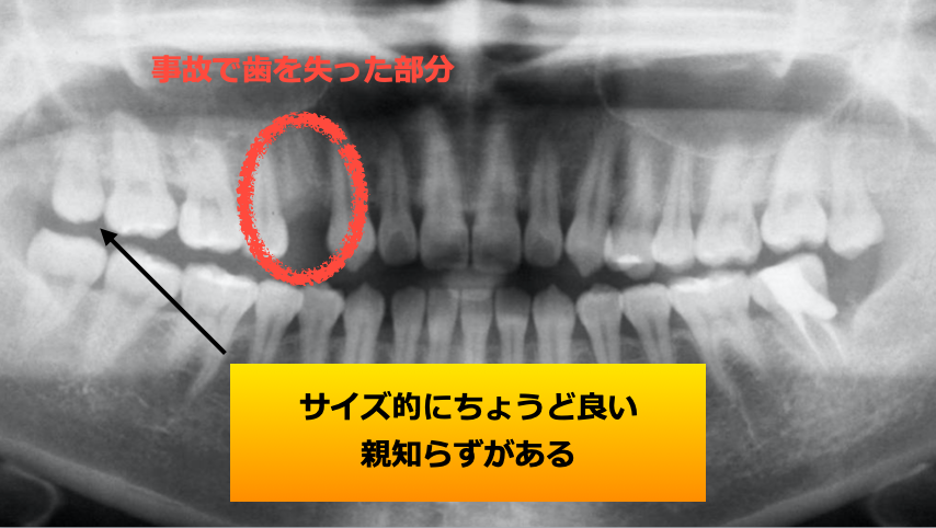 初診時のエックス線写真