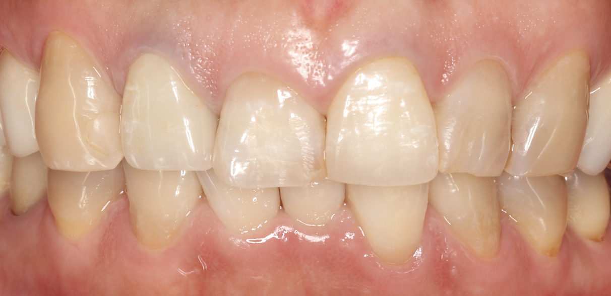 クラウン装着後5年経過時