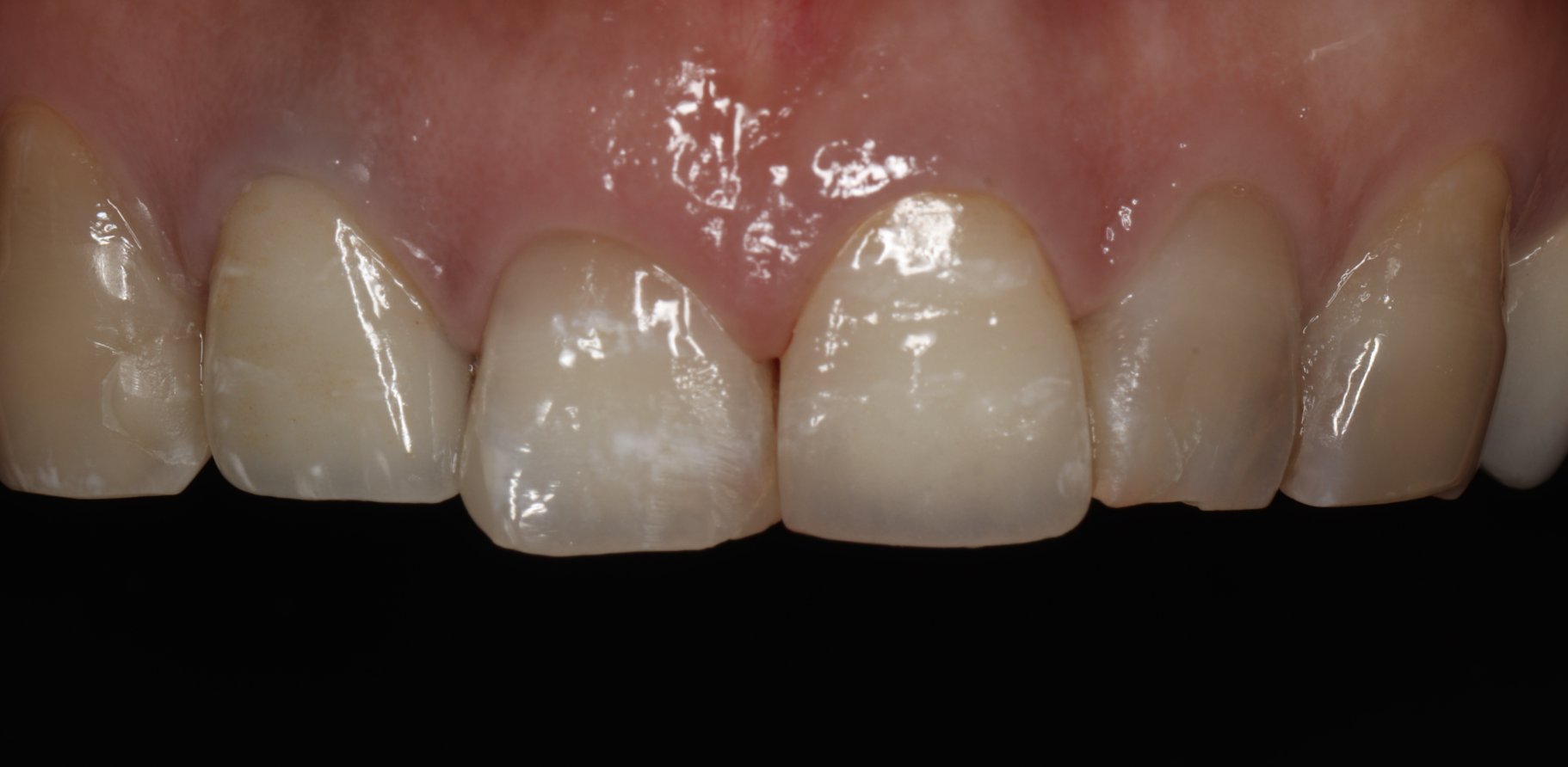 セラミック装着時