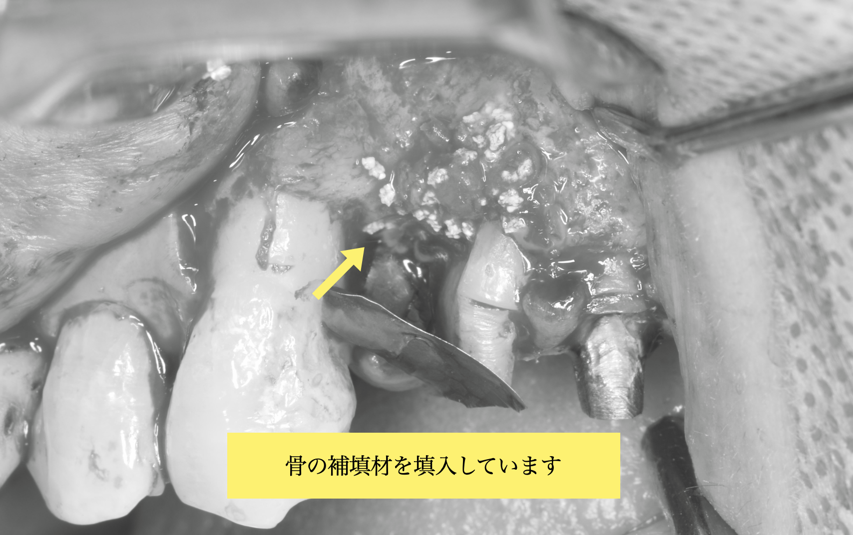 骨欠損部へ骨補填材を填入した状態