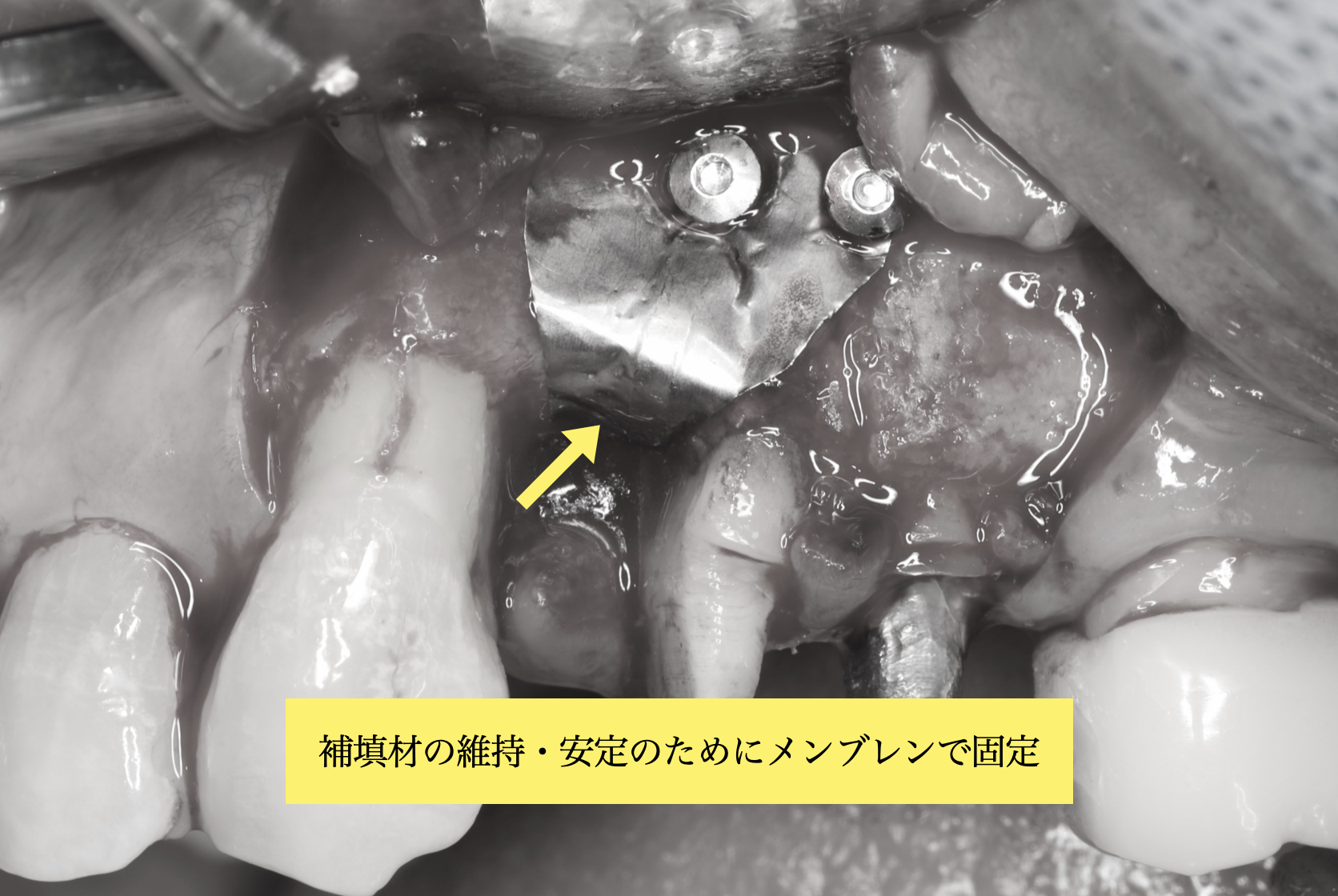補填材の維持・安定のためにチタンメンブレンで固定した状態