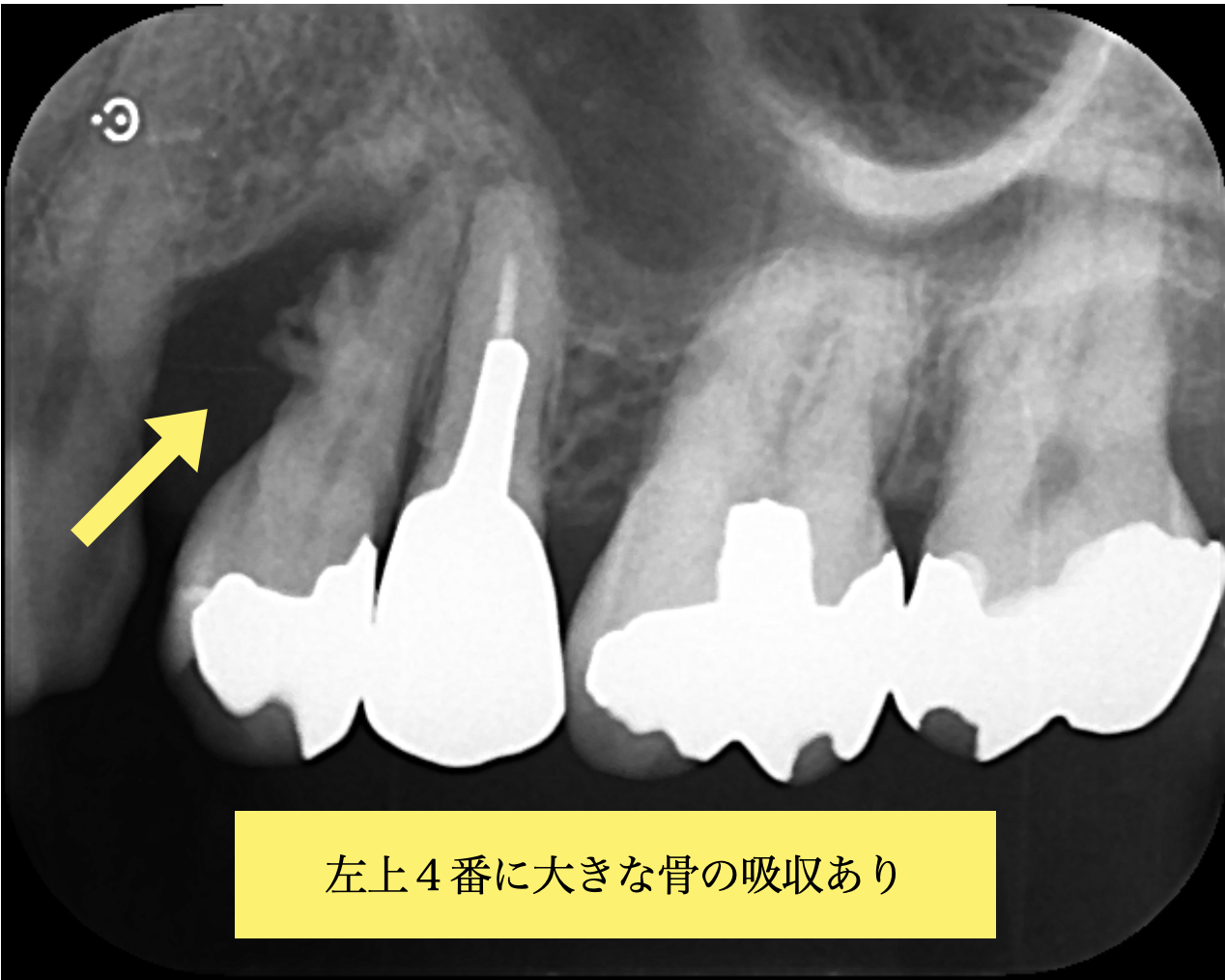 左上4番に大きな骨吸収を認める初診時エックス線写真