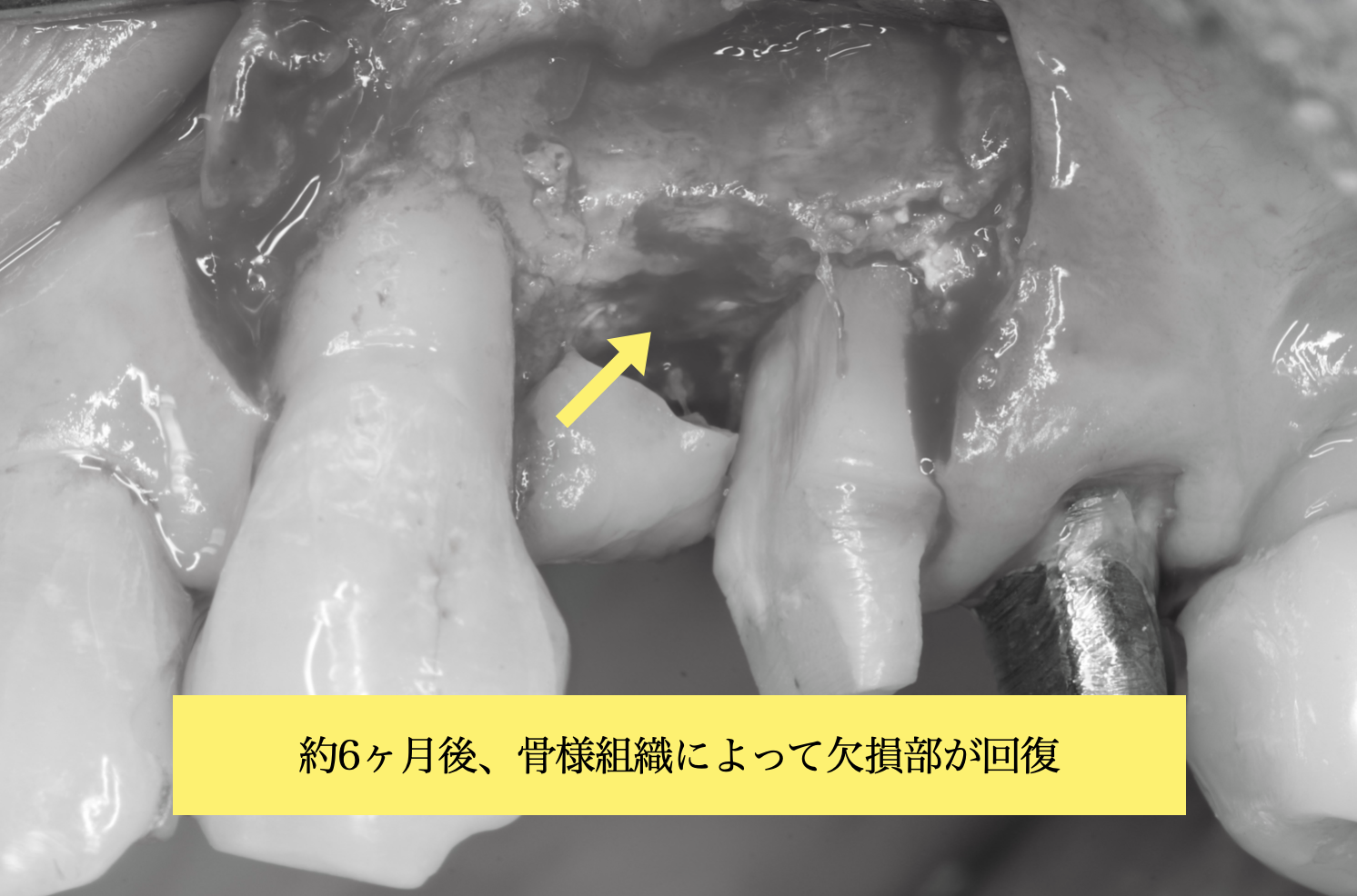 約6か月後の骨の回復状態