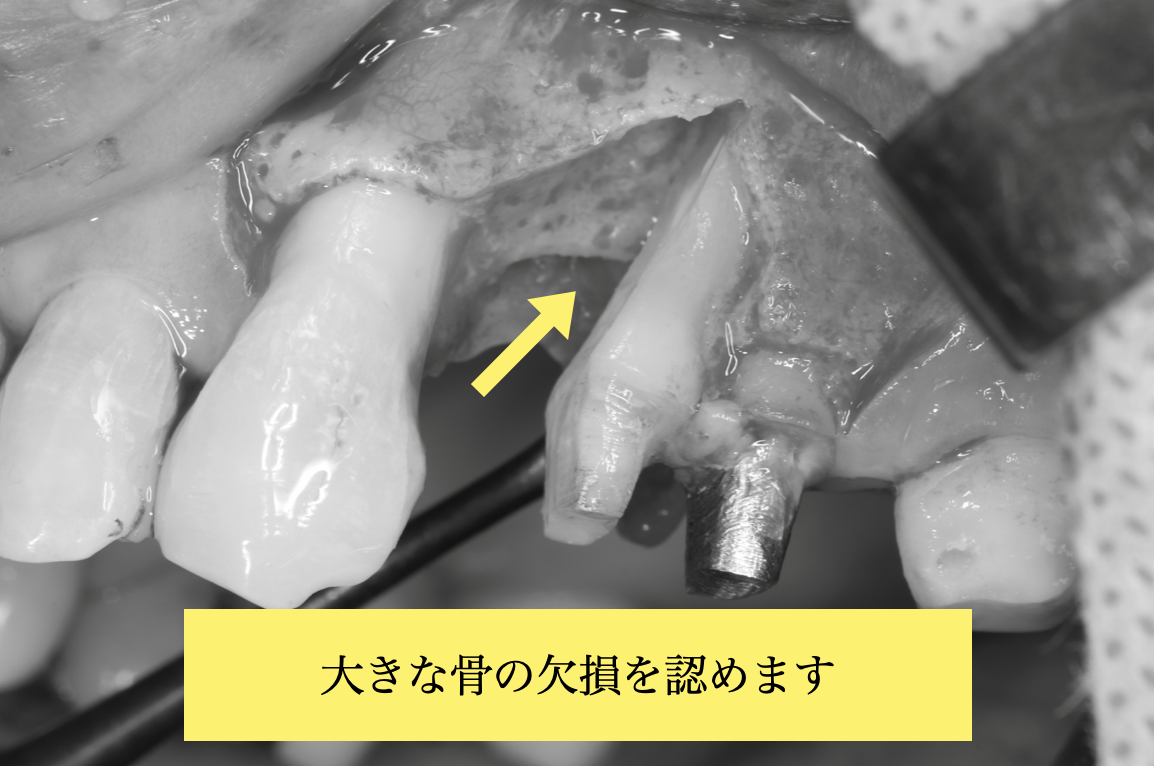 歯周組織再生療法の術中写真
