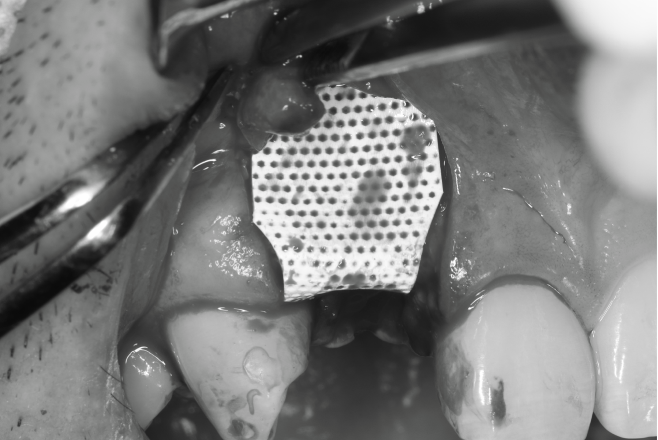 Cytoplast®で補填材を覆う
