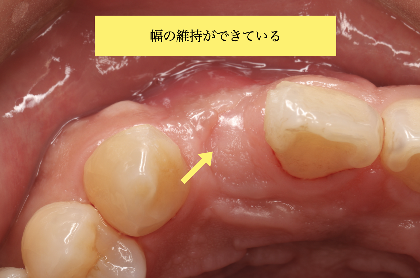 インプラント治療時の口腔内写真