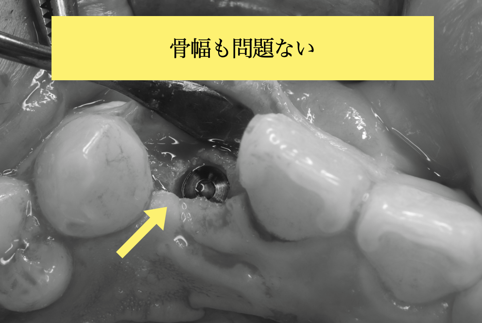 インプラント埋入時の口腔内写真