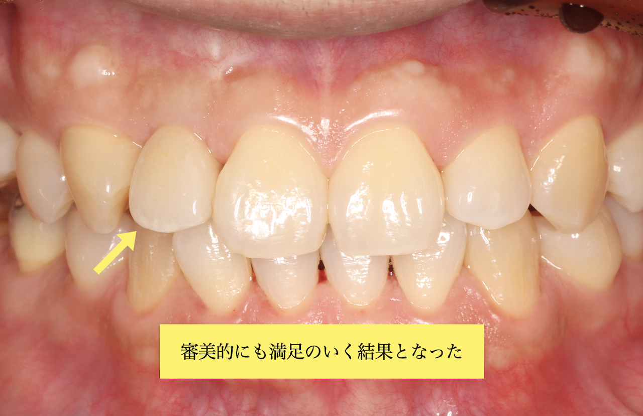 インプラント治療後5年経過時の口腔内写真