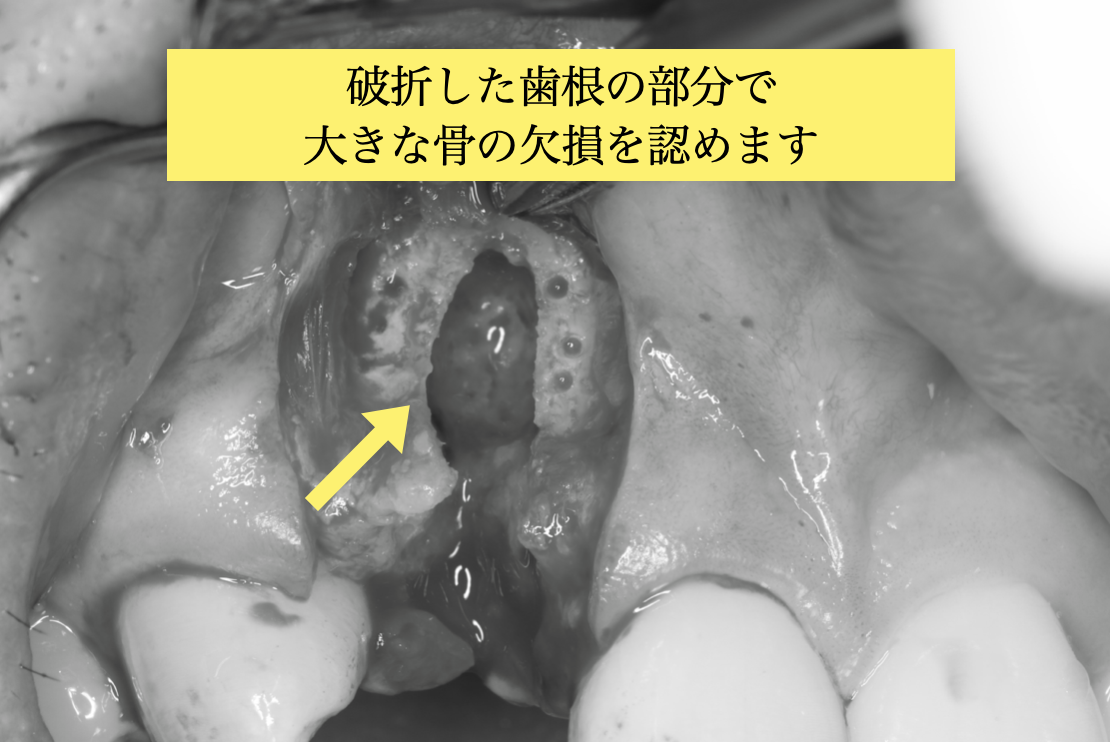 破折した歯根に沿って骨の吸収を認めます