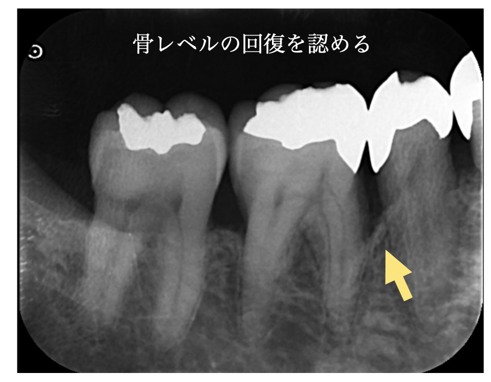 再生療法後5年のエックス線写真では、治療部位にX線上の骨充填が認められ、経過を維持しています