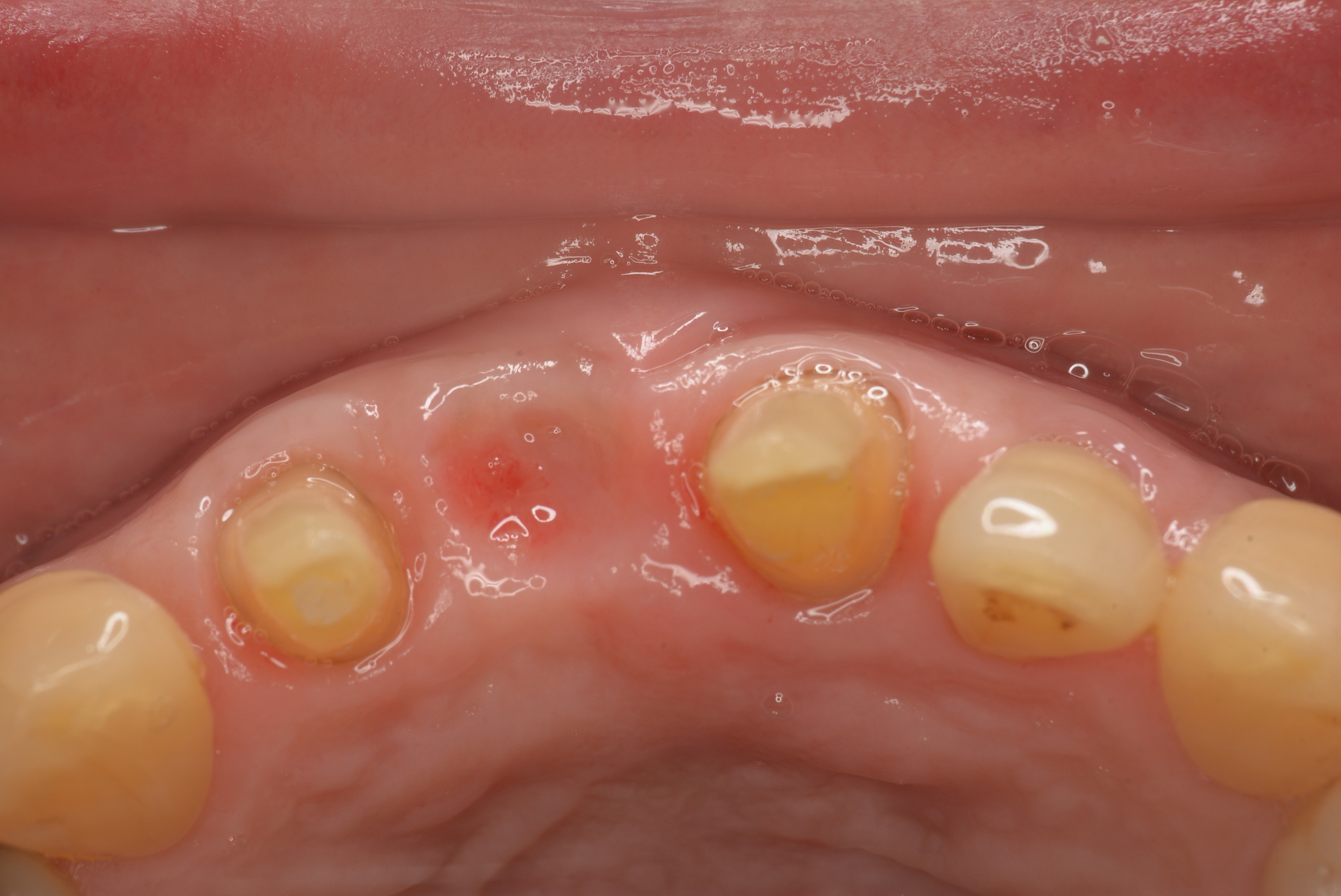 歯肉の幅を出すため歯肉増生手術（結合組織移植術）を行った後の口腔内写真