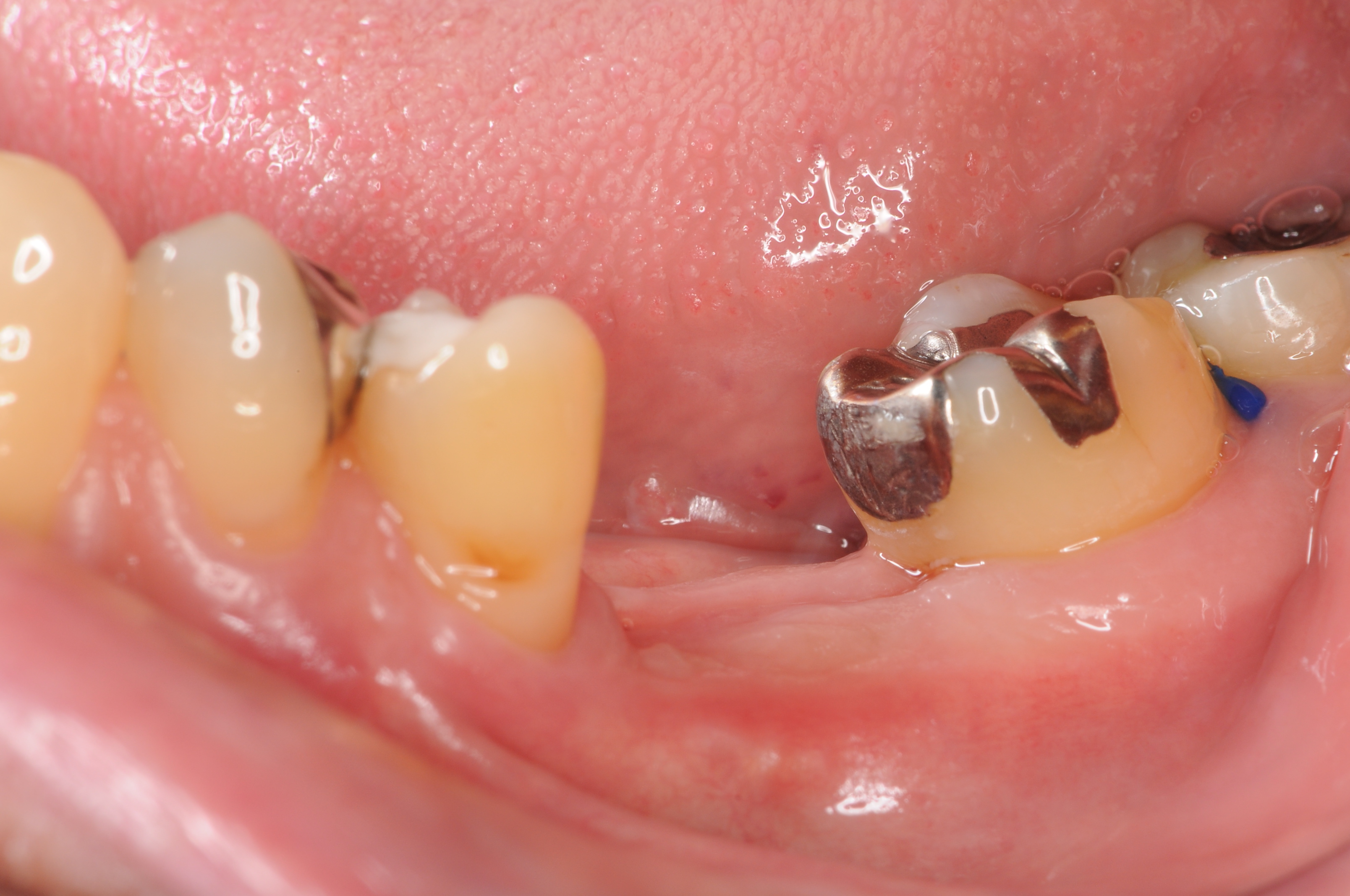 溶け た 歯 再生
